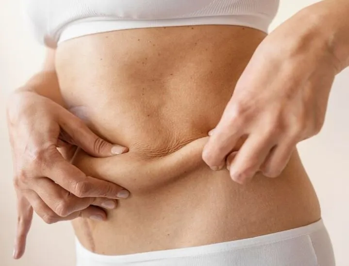 ترهلات الجسم بعد فقدان الوزن الجانب الآخر للدايت